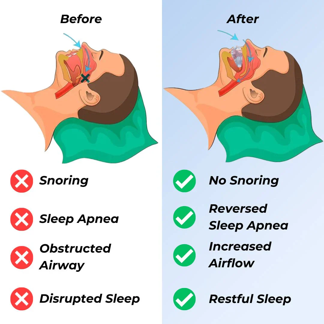 Griqos™ Anti Snoring Mouthpiece - Say goodbye to sleepless nights - Image 3